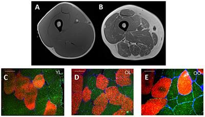 Exploring the Impact of Obesity on Skeletal Muscle Function in Older Age